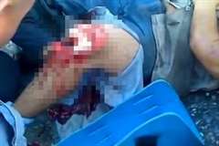 膝が割れ骨がむき出しになっている男性