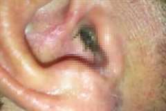 耳の中に何かが住み着いてしまった男性