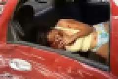 車の事故で顔の皮膚が剥がされ片方の眼球が飛び出してしまった女性