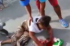 バイク事故で酷いケガを負った人達