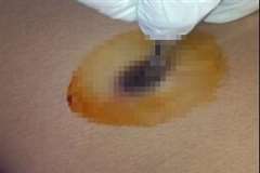 体に埋め込まれた銃弾を摘出する