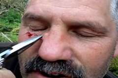 顔面に刺さった釣り針を抜き取る映像