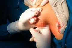 女性の乳房から「乳腺線維腺腫」を摘出する