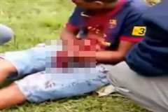 手首から先を花火で吹き飛ばされてしまった少年