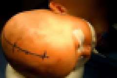 【硬膜下膿瘍】少年の頭部に溜まった膿を手術で取り除く