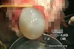 少女の脳から巨大な「包虫嚢胞」を摘出する