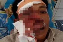 大きな傷を負った男性の顔を修復する手術