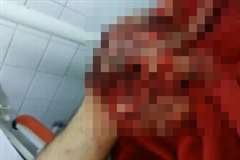 この状態でも指は動く・・・酷く破壊された手の映像