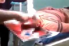 馬に蹴られて額が割れてしまった男性