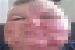 沸騰したお湯を顔面に浴び顔に大火傷を負った男性