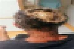 頭蓋骨が露出するほど頭を蛆に侵食された人