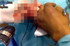 切断されかけた指にドリルを用いて処置を施している映像